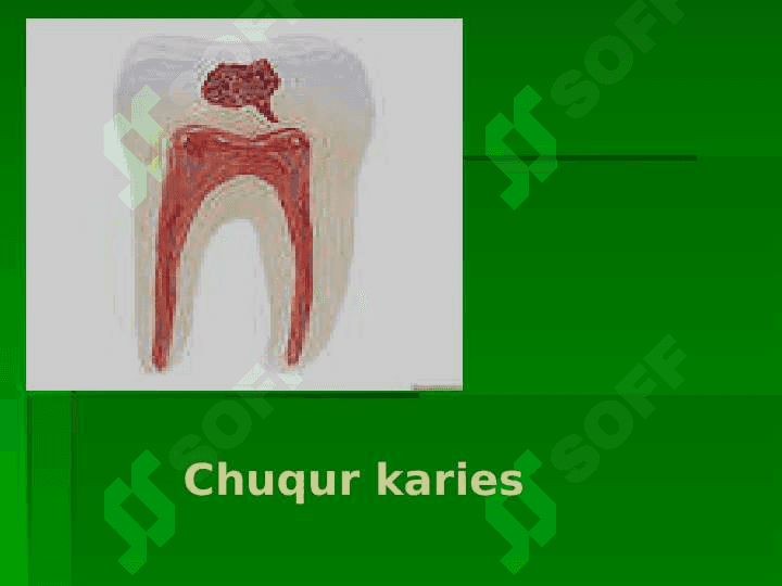 Kariyes , pulpit, periodontit 6