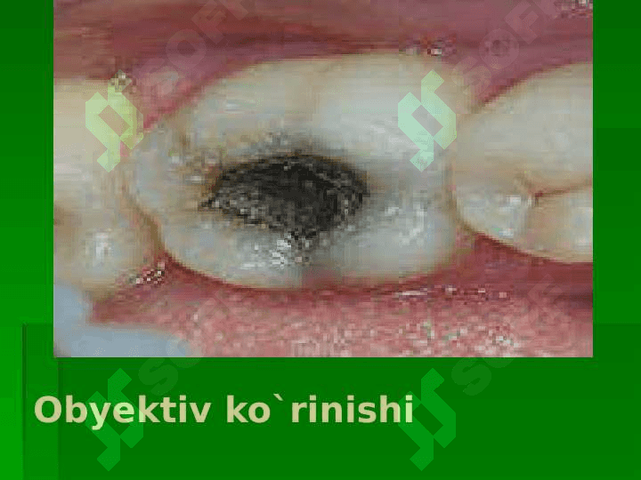 Kariyes , pulpit, periodontit 7