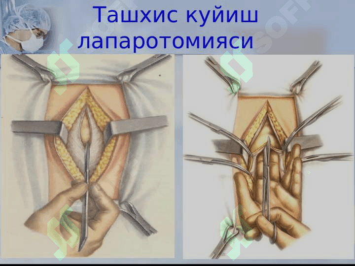 Xirurgik operatsiyalar 4