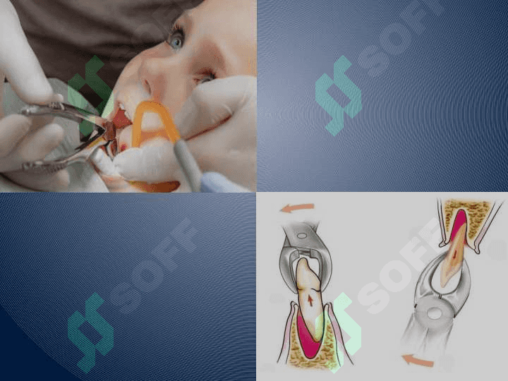 Bolalarda tish olish operatsiyasi 4