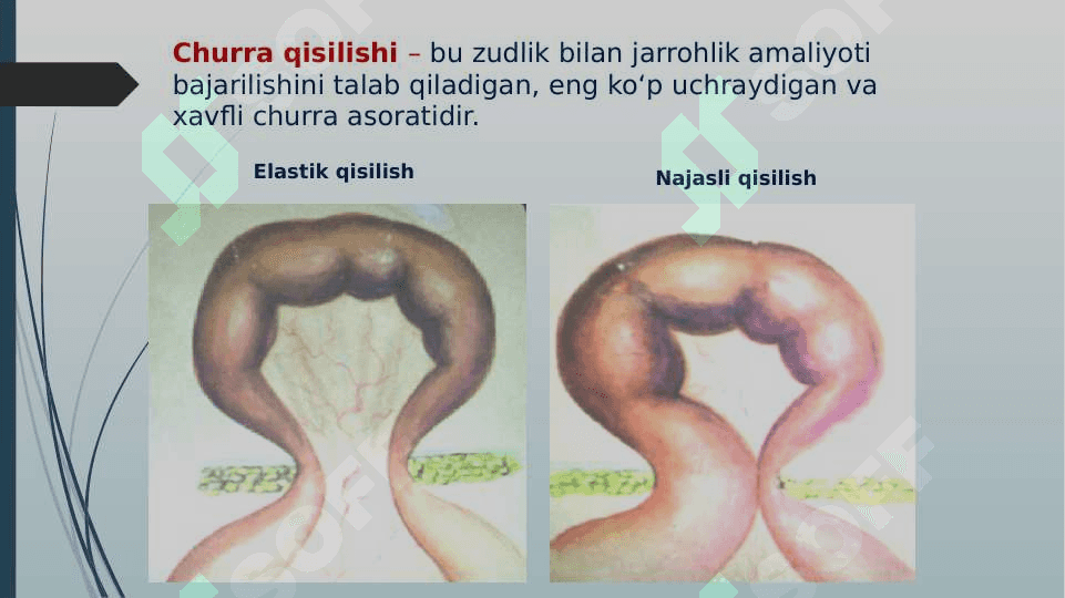 Qorin churralari  va ularning tiurlari. Asoratlari. 4