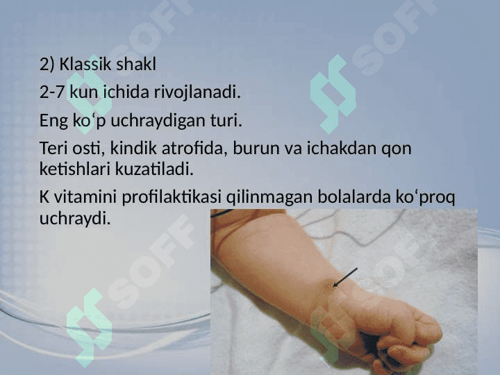 Chaqaloqda gemorragik kasallik 6