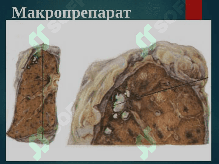 O`PKANING O`CHOQLI YALLIG`LANGAN TUBERKEZI VA O`PKA TUBERKULEMASI 7