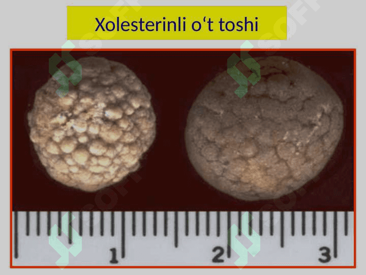 Surunkali xoletsistit. Klinikasi, diagnostikasi, davolash usullari 8