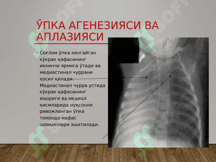Ўпкаларнинг туғма ривожланиш нуқсонлари ва аномалиялари. Диафрагма туғма чурралари 7