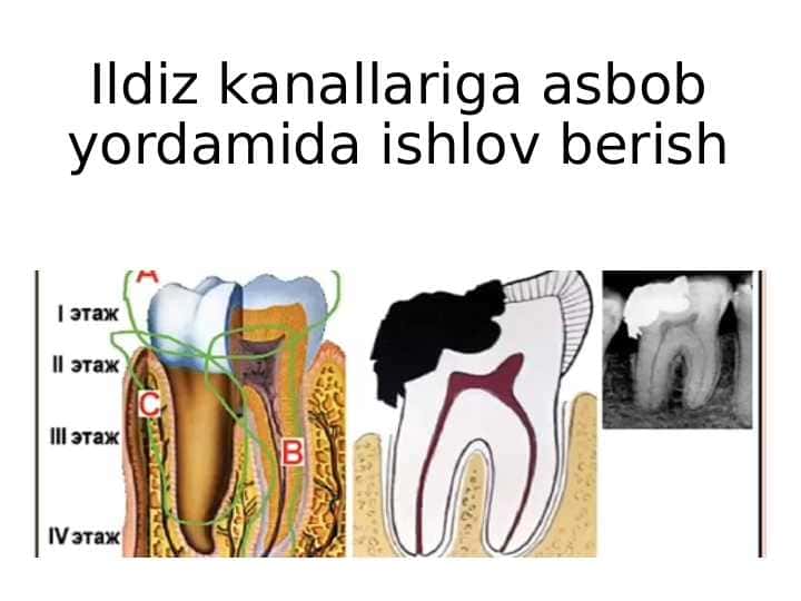 Ildiz kanallariga asbob yordamida ishlov beri 1