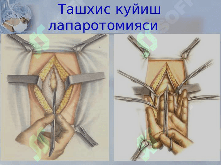 Xirurgik operatsiyalar 4