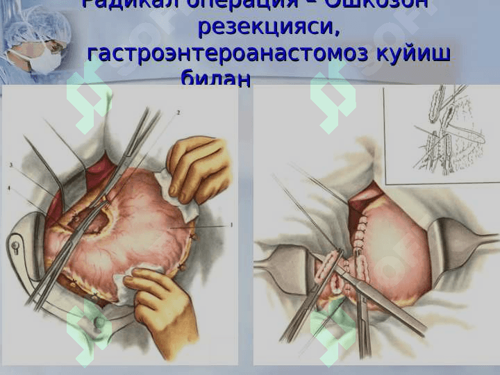 Xirurgik operatsiyalar 7
