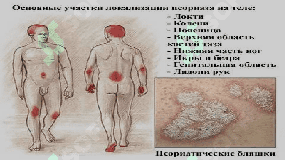 Psoriaz (tangachali temiratki) 3