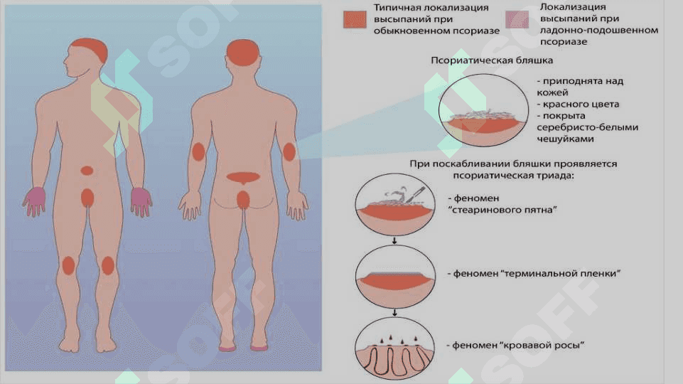 Psoriaz (tangachali temiratki) 5