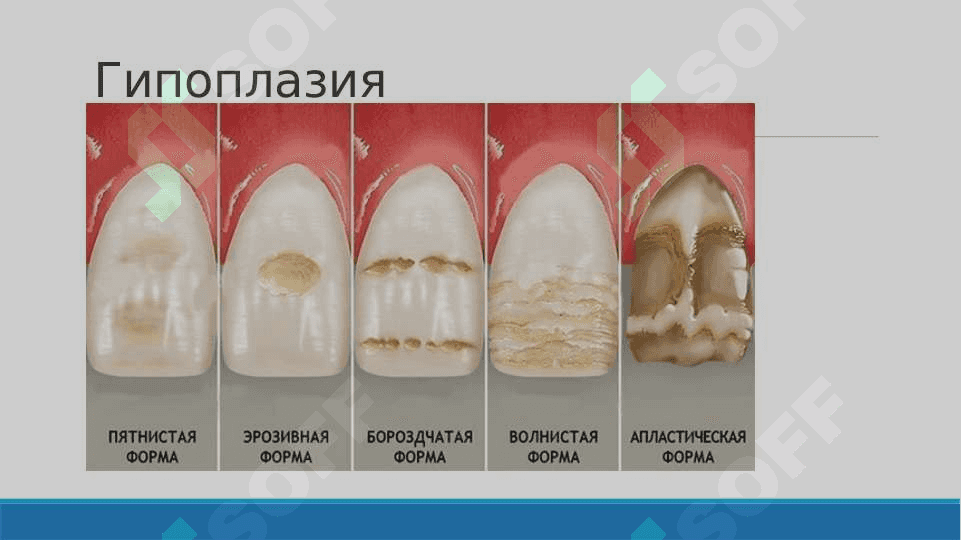 Тиш қопламаларининг қисман бузилиши. Этиология, патогенез, клиник кўриниши. Тиш қаттиқ тўқимасининг зарарланиш таснифи. Қаттиқ тўқималар зарарланиши билан оғриган беморларни текшириш хусусиятлари. Тишларнинг қаттиқ тўқималари зарарланишини қўшимча текшириш усуллари. 7