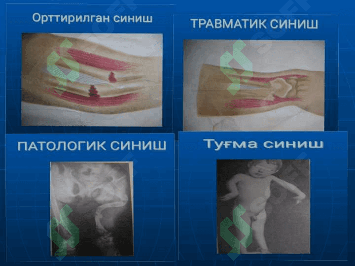 Tayanch harakat apparati sinishlari va chiqishlarini tashxislash. Birinchi tibbiy yordam. Transportli immobilizatsiya. Gips texnikasi. Skelet va leykoplastirli tana tortmasi 4