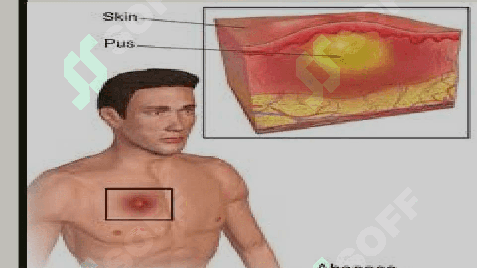 O'pka abssesi 3