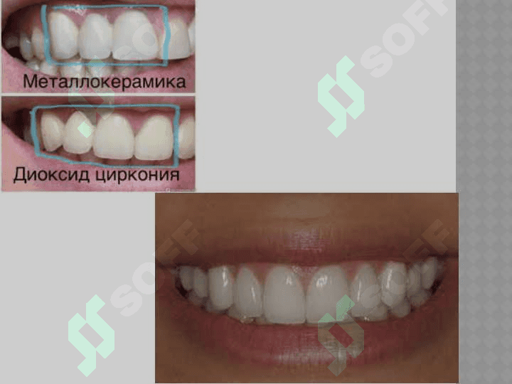 Dioksid sirkon . Cad cam tizimi 5