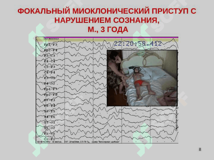 СЕМИОЛОГИЯ ЭПИЛЕПТИЧЕСКИХ ПАРОКСИЗМОВ . ЭПИЛЕПТИЧЕСКИЙ СТАТУС 8