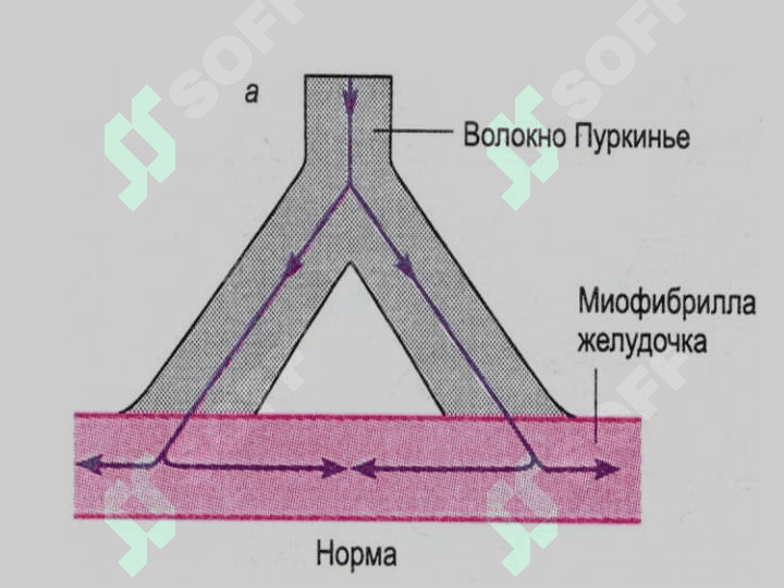 Аритмия 6