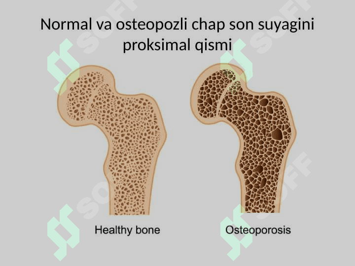 Osteoporoz 3