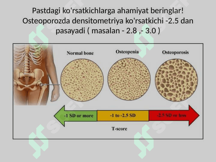Osteoporoz 4