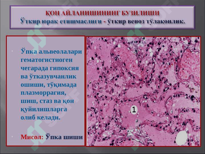 Қон айланишининг бузилиши. Артериал ва веноз тўлақонлик. Қон кетиши”” 6