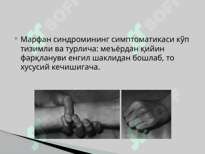 Marfan Sindromi . Марфан синдроми 4