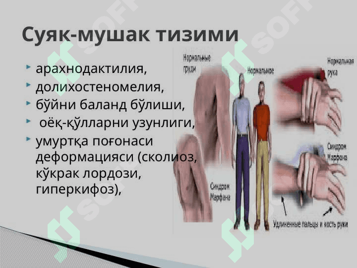 Marfan Sindromi . Марфан синдроми 7