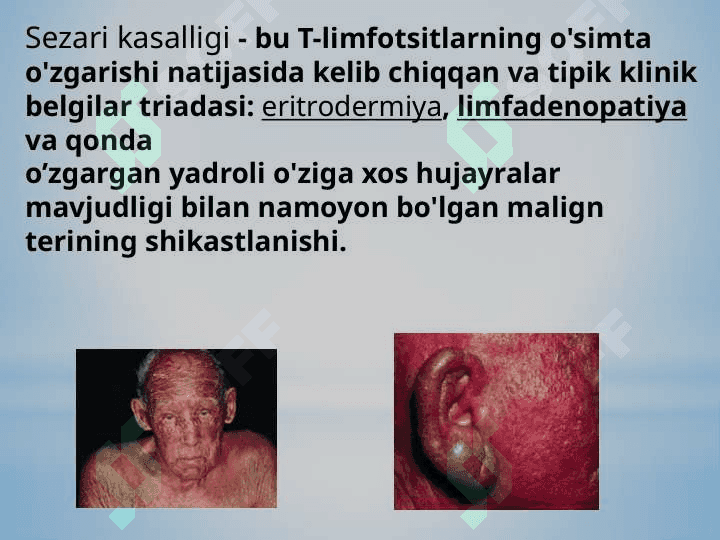 Sezari sindromi (teri limfotsitomasi) 2