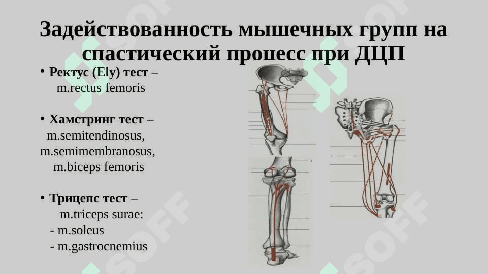 Ортопедические аспекты детского церебрального паралича 3