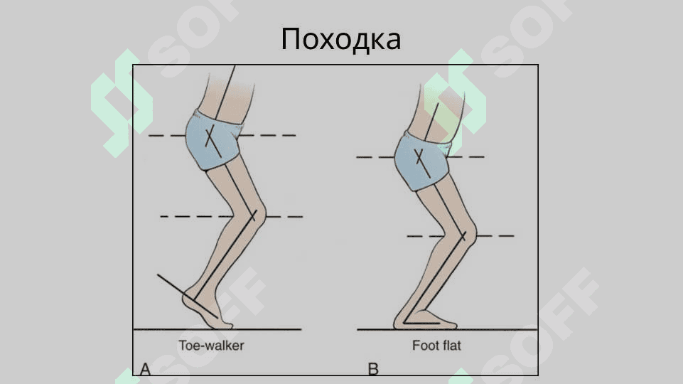 Ортопедические аспекты детского церебрального паралича 4