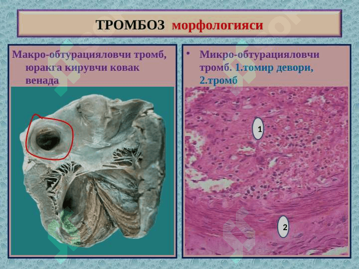 “Тромбоз. Эмболия. Стаз. Инфаркт”” 8