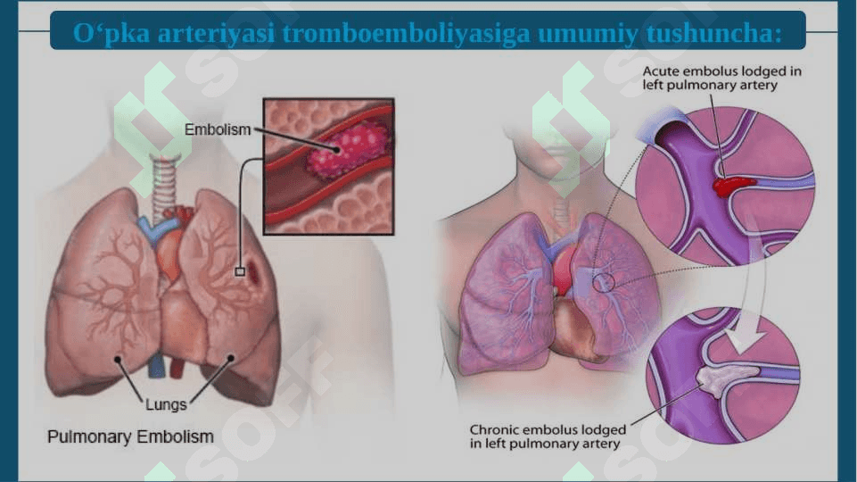 O‘PKA ARTERIYASI TROMBOEMBOLIYASI 6