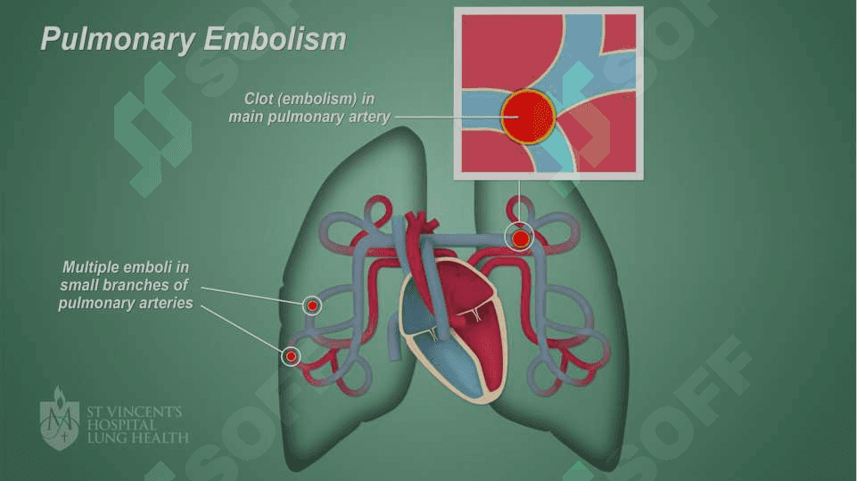 O‘PKA ARTERIYASI TROMBOEMBOLIYASI 8