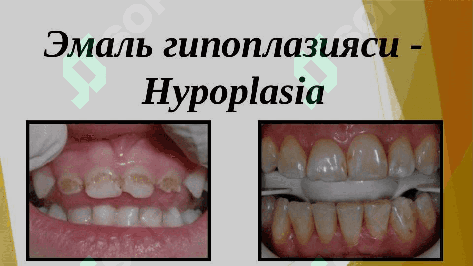 Tish rivojlanish gistogenez davrida sodir boʻladigan nokaries kasalliklar. Nasliy kasalliklar. Etiologiyasi, patogenezi, tasnifi, klinikasi, davolash va profilaktikasi 4
