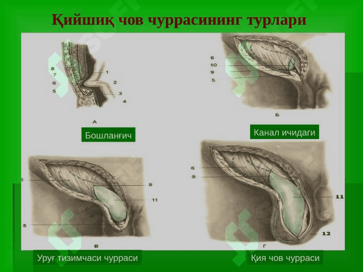Chov, son, kindik va qorin oq chizigʻi churralari 6