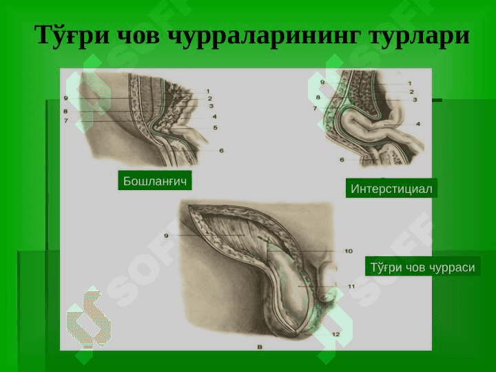Chov, son, kindik va qorin oq chizigʻi churralari 7