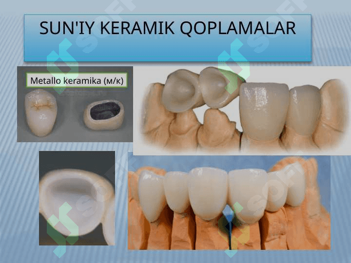 Sirkoniydioksid stomatologik keramika farfor 4