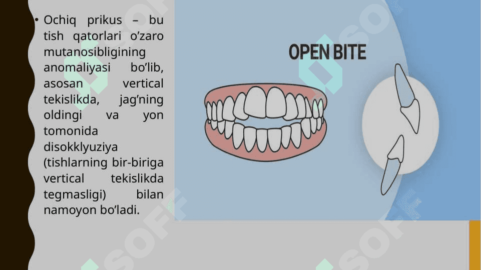 Ochiq prikus. Ochiq prikus turlari. Etiopatogenezi.Ochiq prikusning klinikasi, tashxisi va davolash usullari. 2
