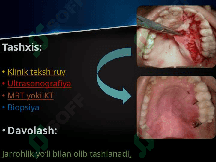 So’lаk bеzlаri o’smаlаri. Mоnоmоrf аdеnоmа, pоlimоrf аdеnоmа, mukоepidеrmоid o’smа. Klinikаsi, tаshxislаsh vа dаvоlаsh. Аdеnоkаrsinоmа. Tаshxislаsh vа dаvоlаsh prinsiplаri. 4