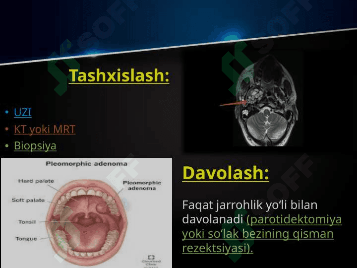 So’lаk bеzlаri o’smаlаri. Mоnоmоrf аdеnоmа, pоlimоrf аdеnоmа, mukоepidеrmоid o’smа. Klinikаsi, tаshxislаsh vа dаvоlаsh. Аdеnоkаrsinоmа. Tаshxislаsh vа dаvоlаsh prinsiplаri. 6