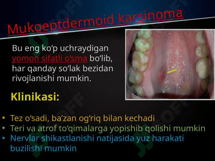 So’lаk bеzlаri o’smаlаri. Mоnоmоrf аdеnоmа, pоlimоrf аdеnоmа, mukоepidеrmоid o’smа. Klinikаsi, tаshxislаsh vа dаvоlаsh. Аdеnоkаrsinоmа. Tаshxislаsh vа dаvоlаsh prinsiplаri. 7