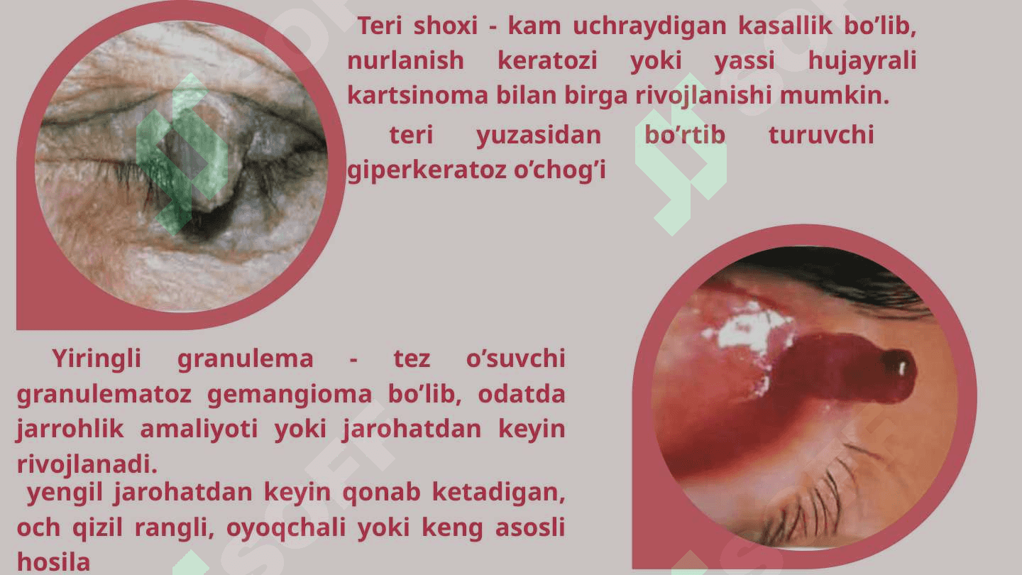 Ko'ruv a'zosi o'smalari 4