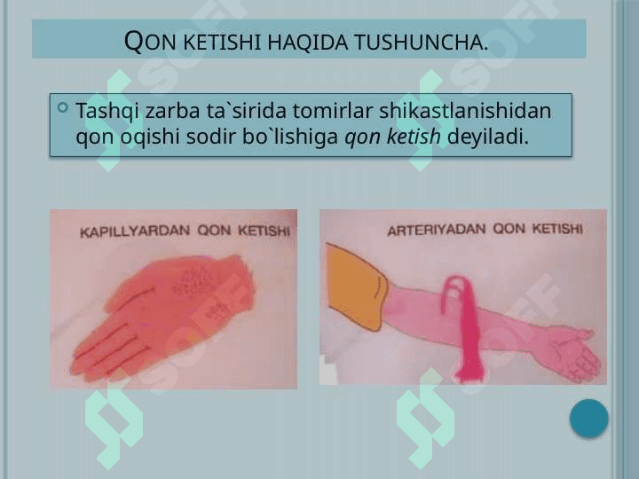 Qon ketish turlari, qon ketishini to’xtatish usullari 2