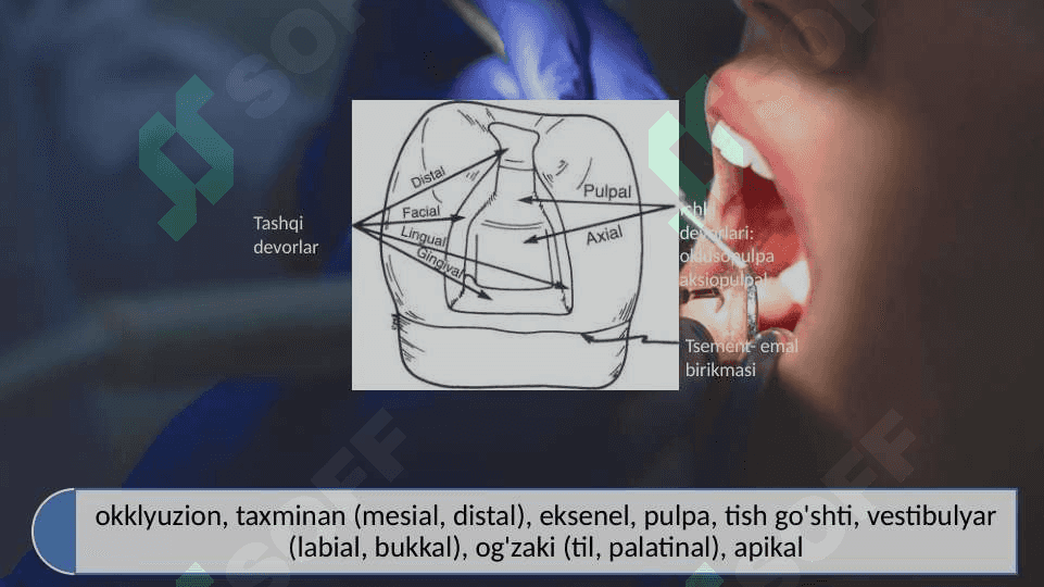 Blek bo‘yicha III- IV sinfli karies kovaklarini restavratsiya qilishning klinik tamoyillari. 5