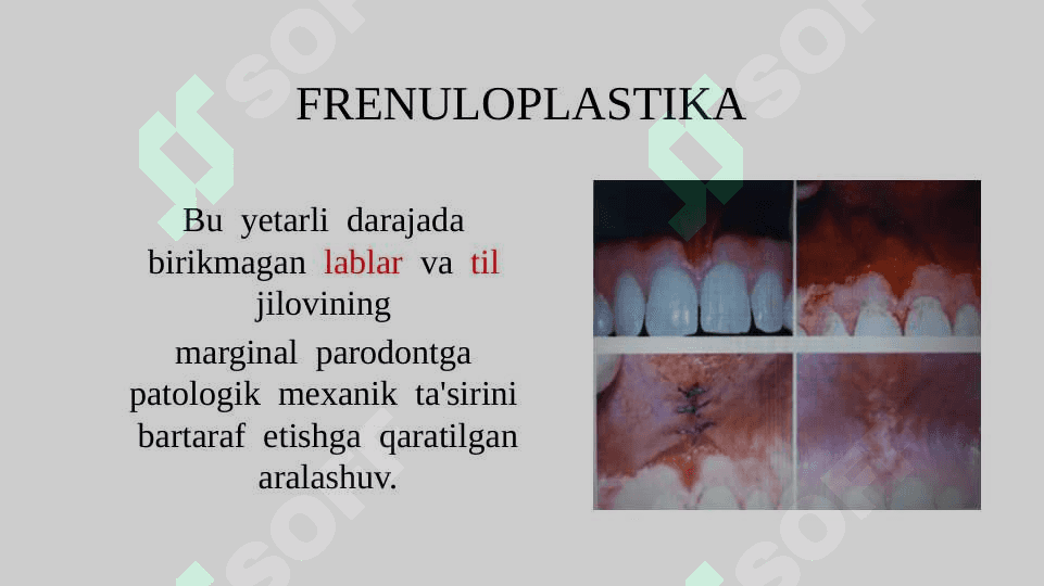 Ogʻiz bo’shligʼini protezlashga tayorlash. Til va lab yuganchalarini  bartaraf etish. 3