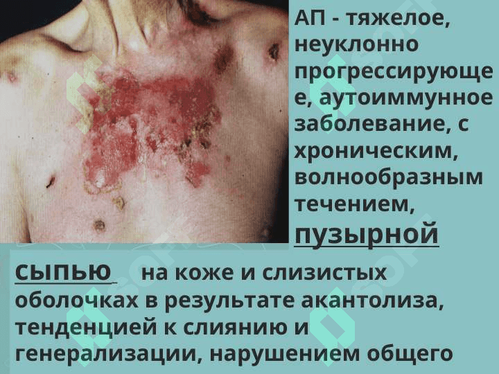 Пузырные дерматозы 6