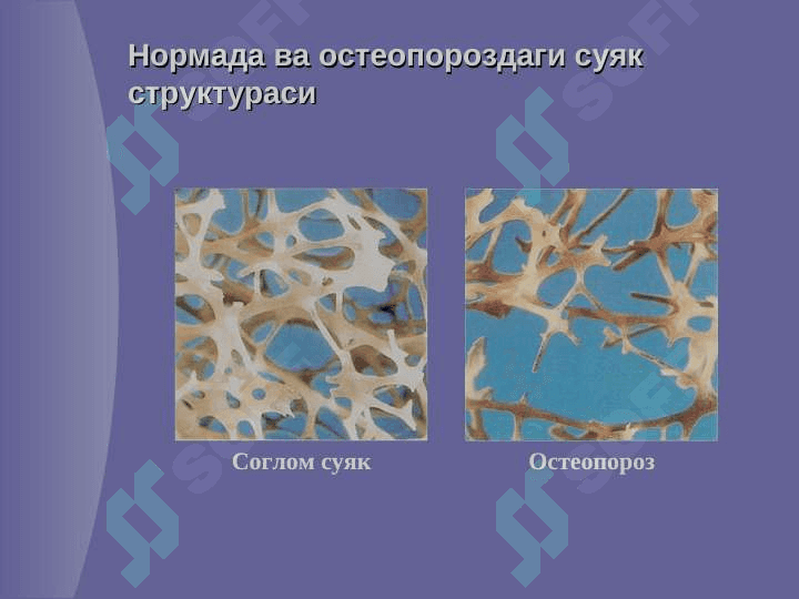 Остеопороз 5