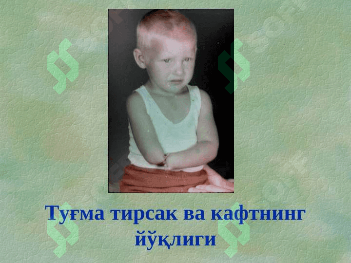 Туғма оёқ-қўл нуқсонлари 5