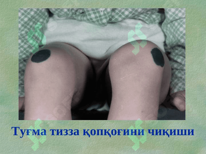 Туғма оёқ-қўл нуқсонлари 6