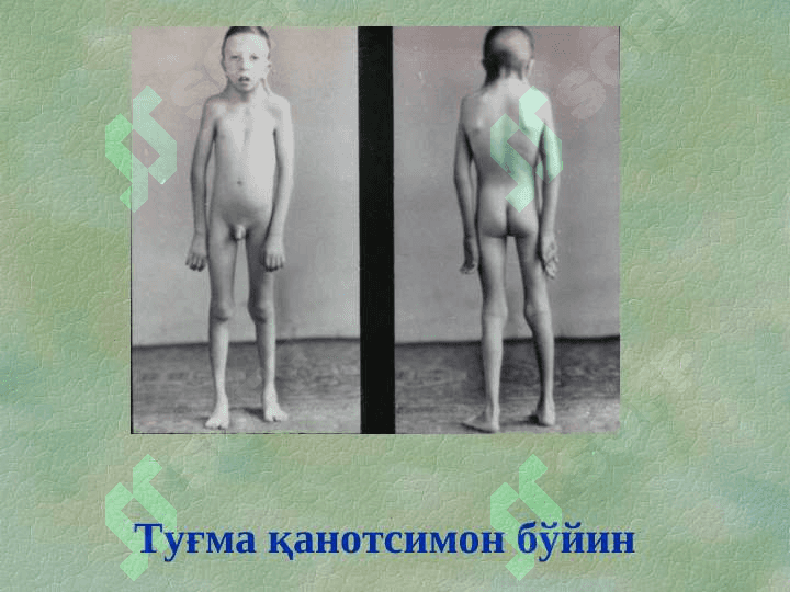 Туғма оёқ-қўл нуқсонлари 8