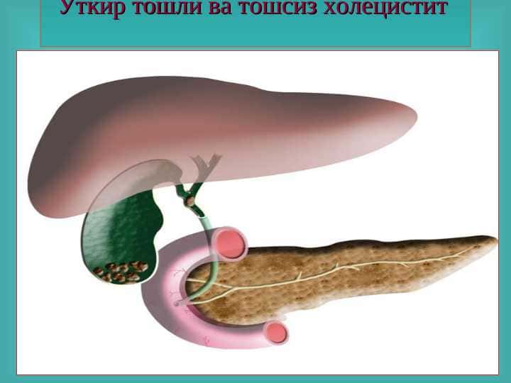 Ўт тош ва тошсиз холецистит