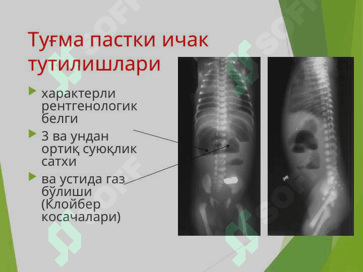 Ичак тутилиши 7